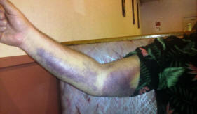 Paul's bad arm.