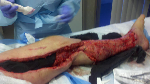 January 21st: A week after my first two surgeries.