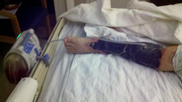 My leg covered in foam for the wound vac.