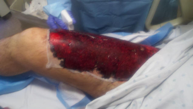 The donor site for my first two skin grafts.