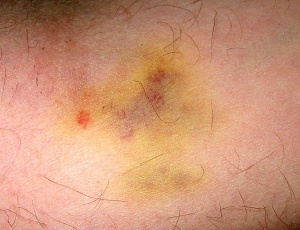 Painless bruises are a symptom of abduction.